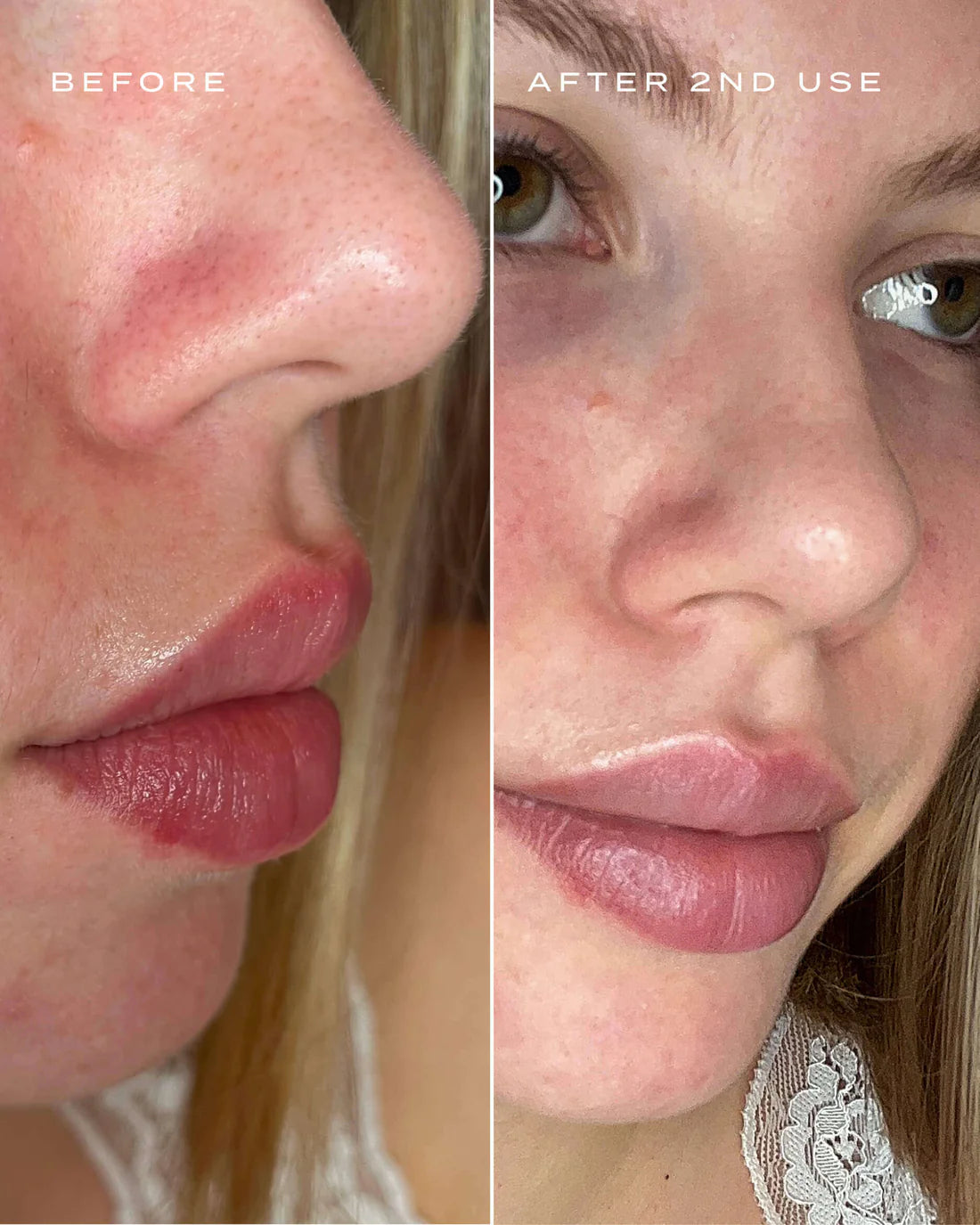 Guiletta Nose Patches™